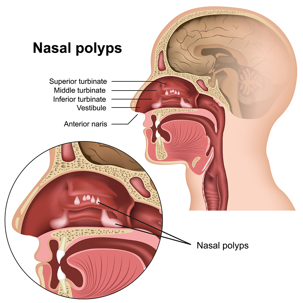 Medical illustration of nasal polyps