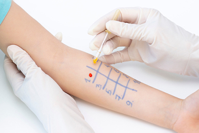 Allergy specialist administering diagnostic skin prick test for allergic response